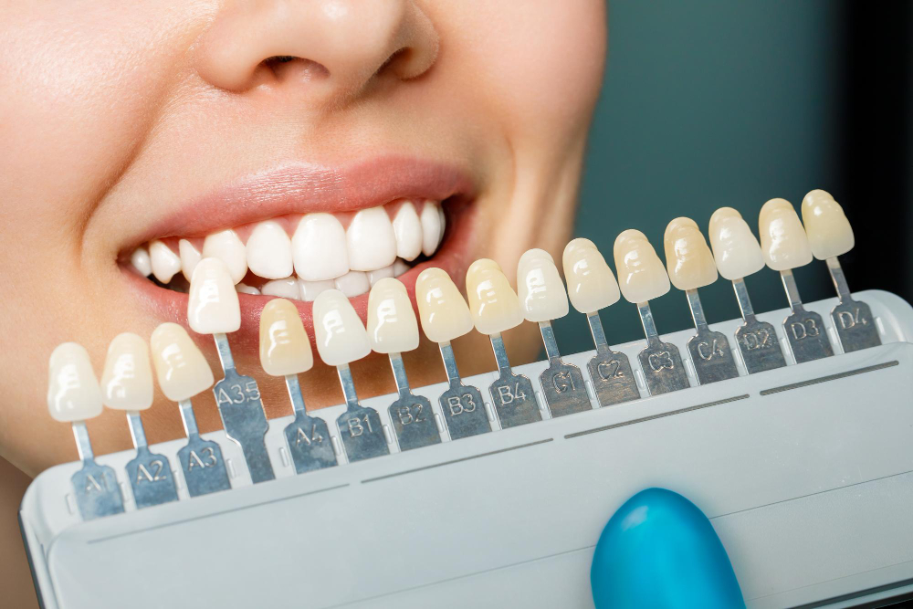 Fatetele dentare: beneficii și riscuri